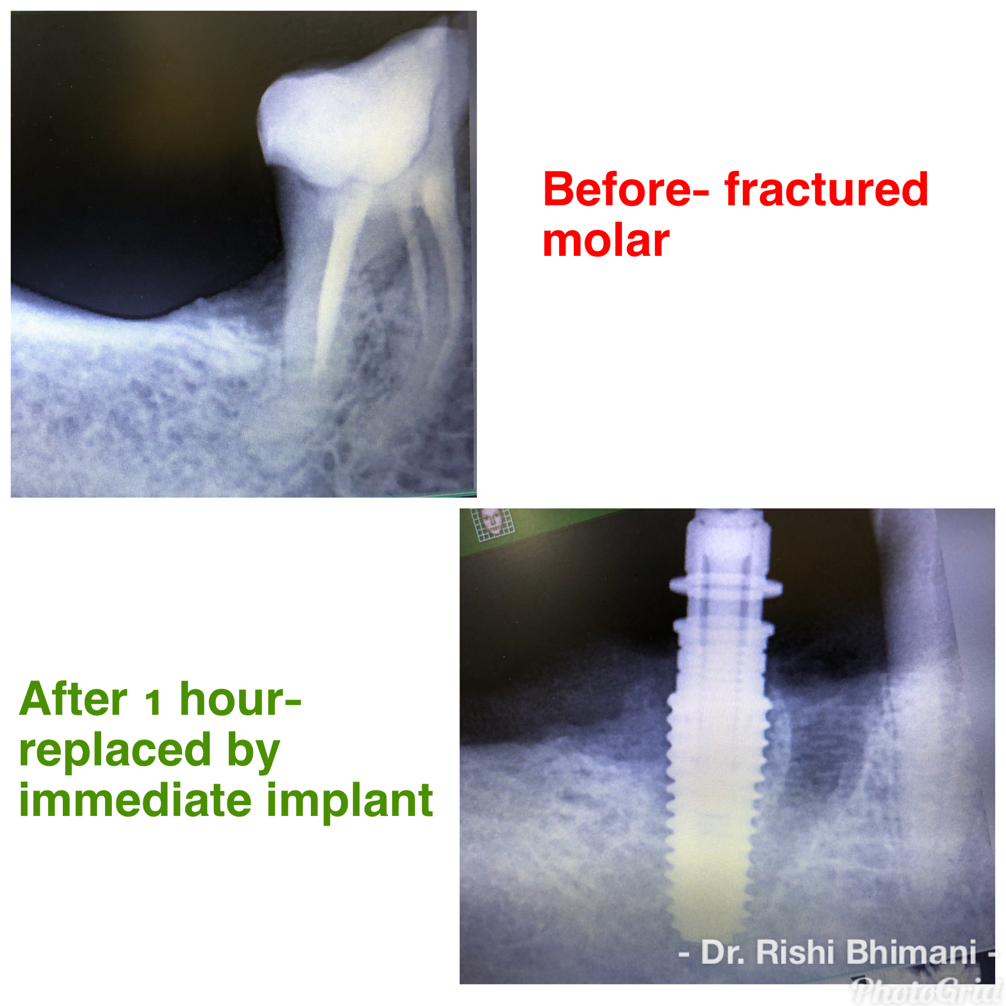 Immediate dental implants done to replace broke... main image