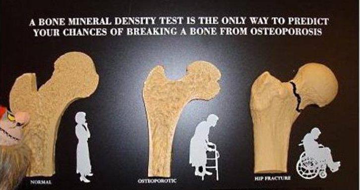 What Is A Bone Mineral Density Test A Bone Mineral Density Test Sometimes Just Called A Bone Density Test Detects Whether You Have Osteoporosis A Word That Comes From Greek And Literally