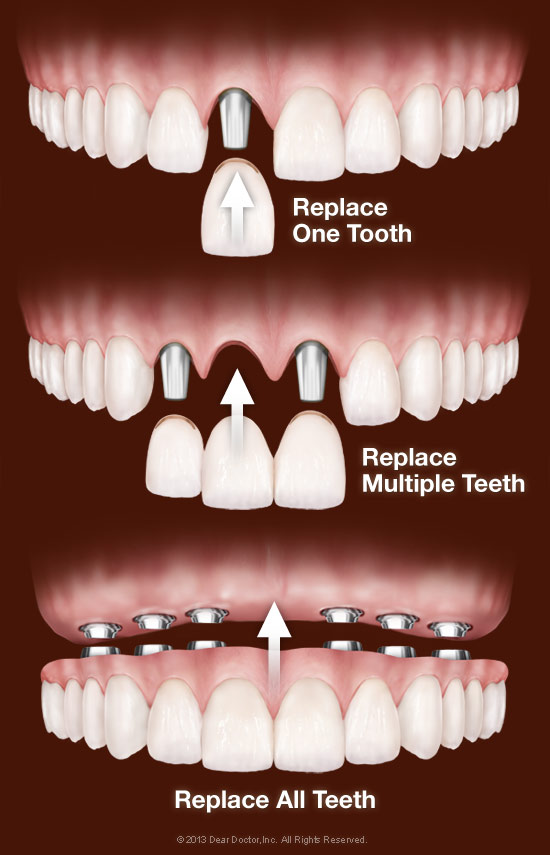 best dental implants
dental implants navi mumba... main image