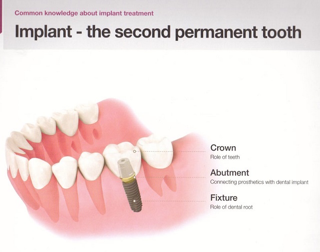 Dental implant can be the 2nd permanent tooth. ... main image
