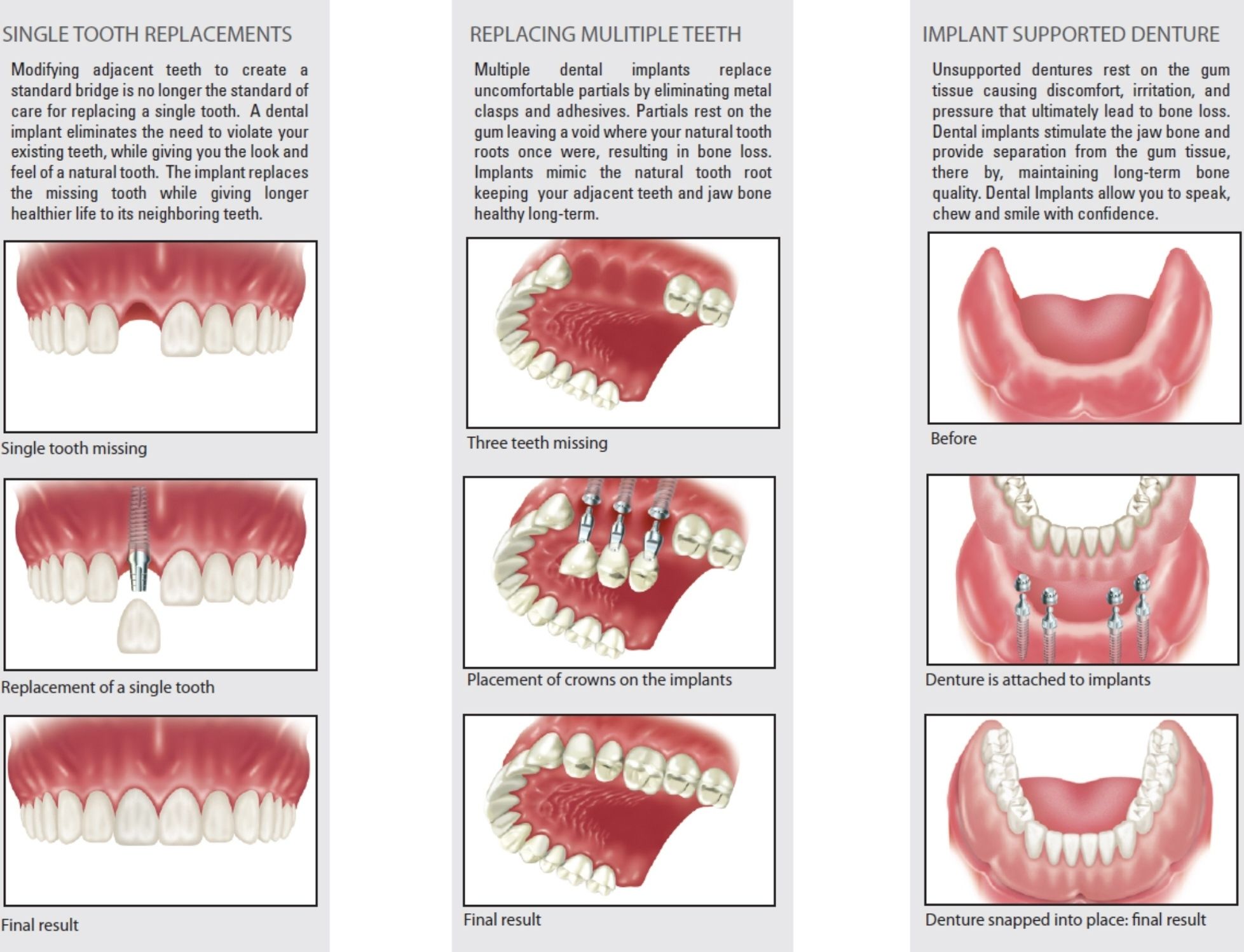Dental implants are the permanent solution to r... main image