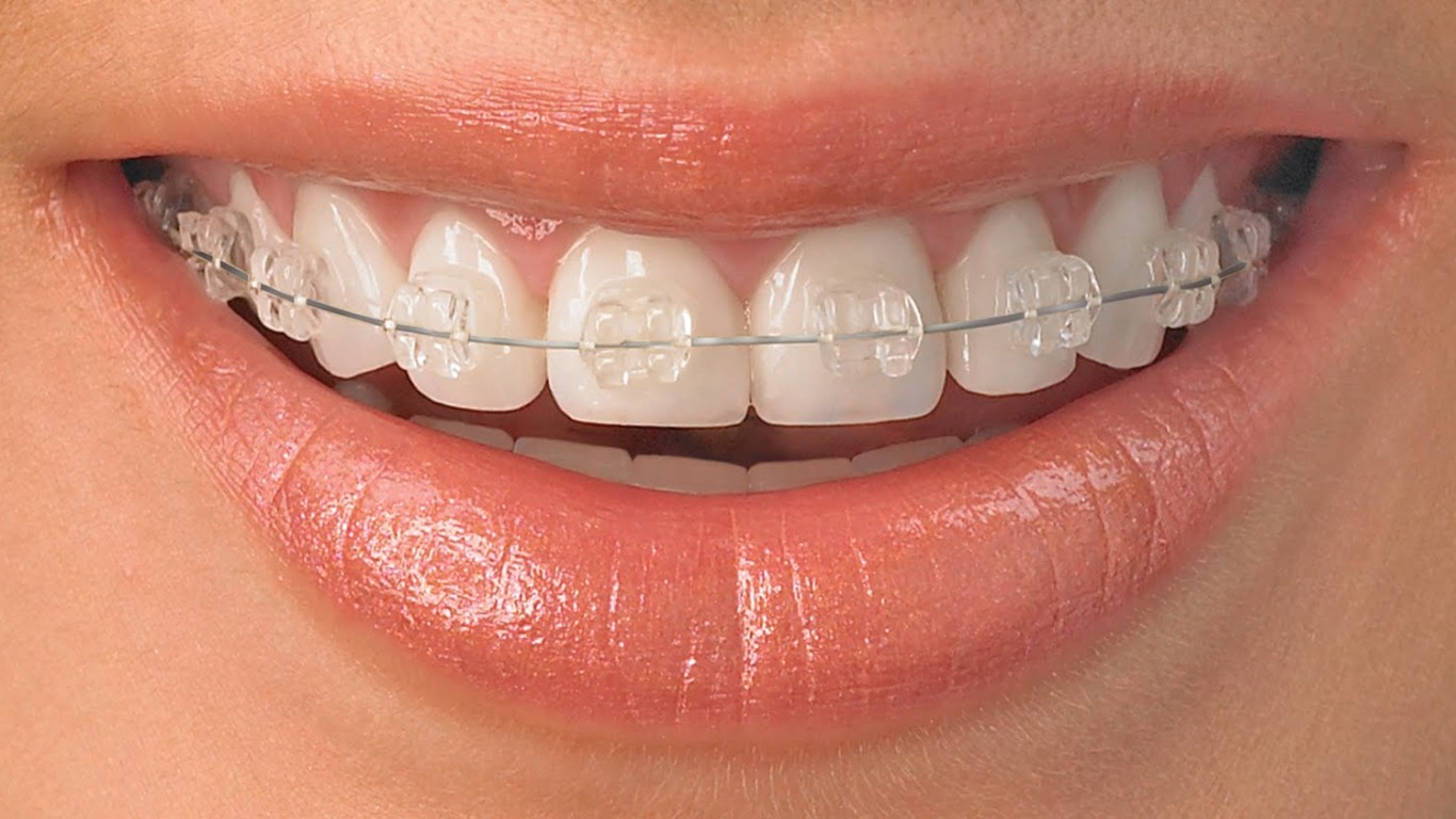 Braces (orthodontic treatment) not only correct... main image