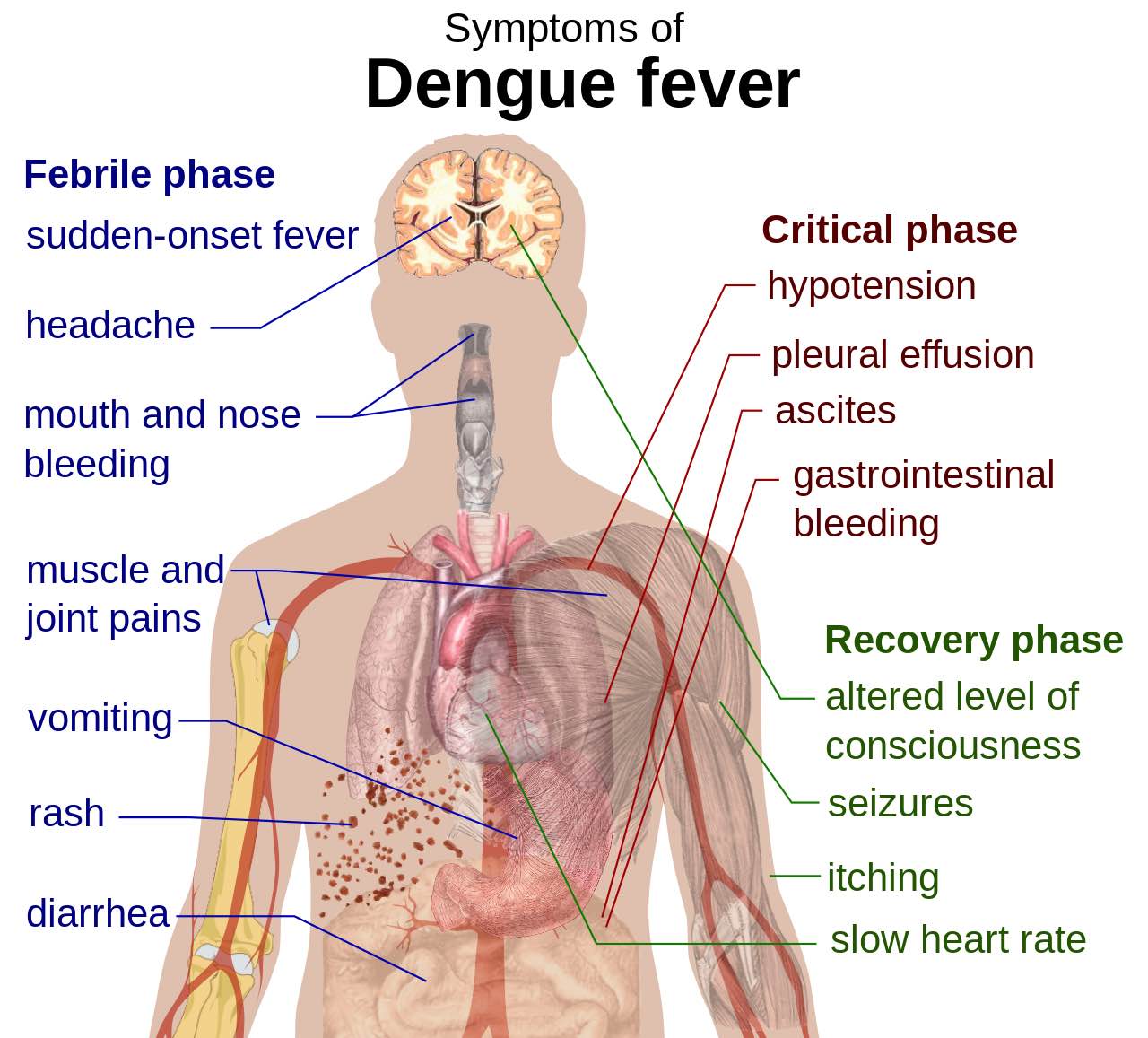 Dengue Fever Pronounced Den Gi Is An Infectious Disease Caused By The Dengue Virus People Get The Dengue Virus From Mosquitoes Dengue Fever Is Also Called Break Bone Fever Because It Can Cause So