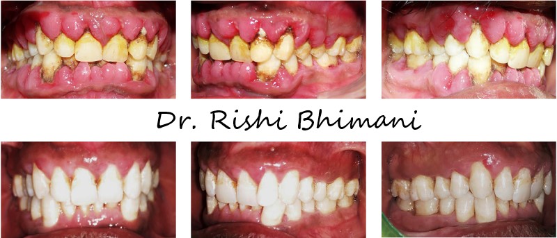 Gum disease is a silent killer as it does not g... main image