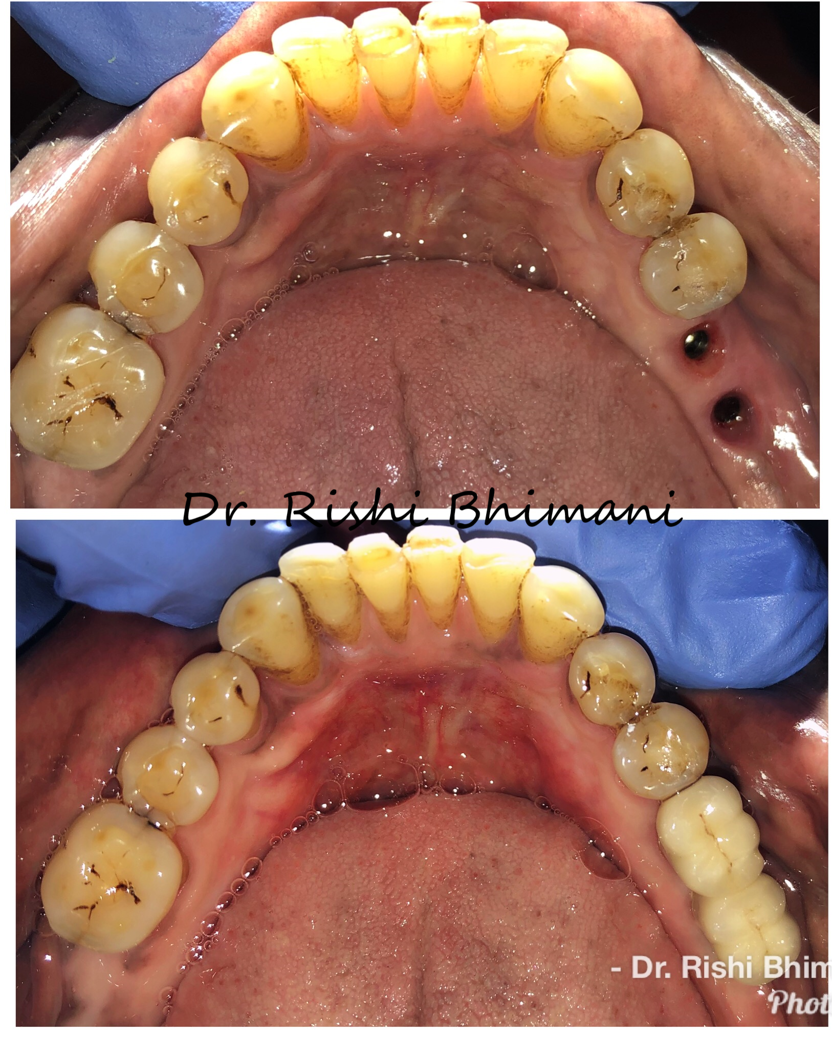 Dental implants can replace missing teeth perma... main image