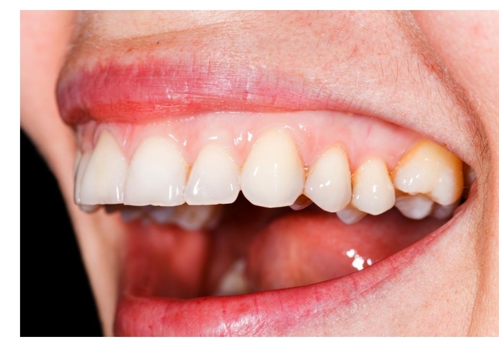 What causes pale gums ? Healthy gums do have a consistent pink colour