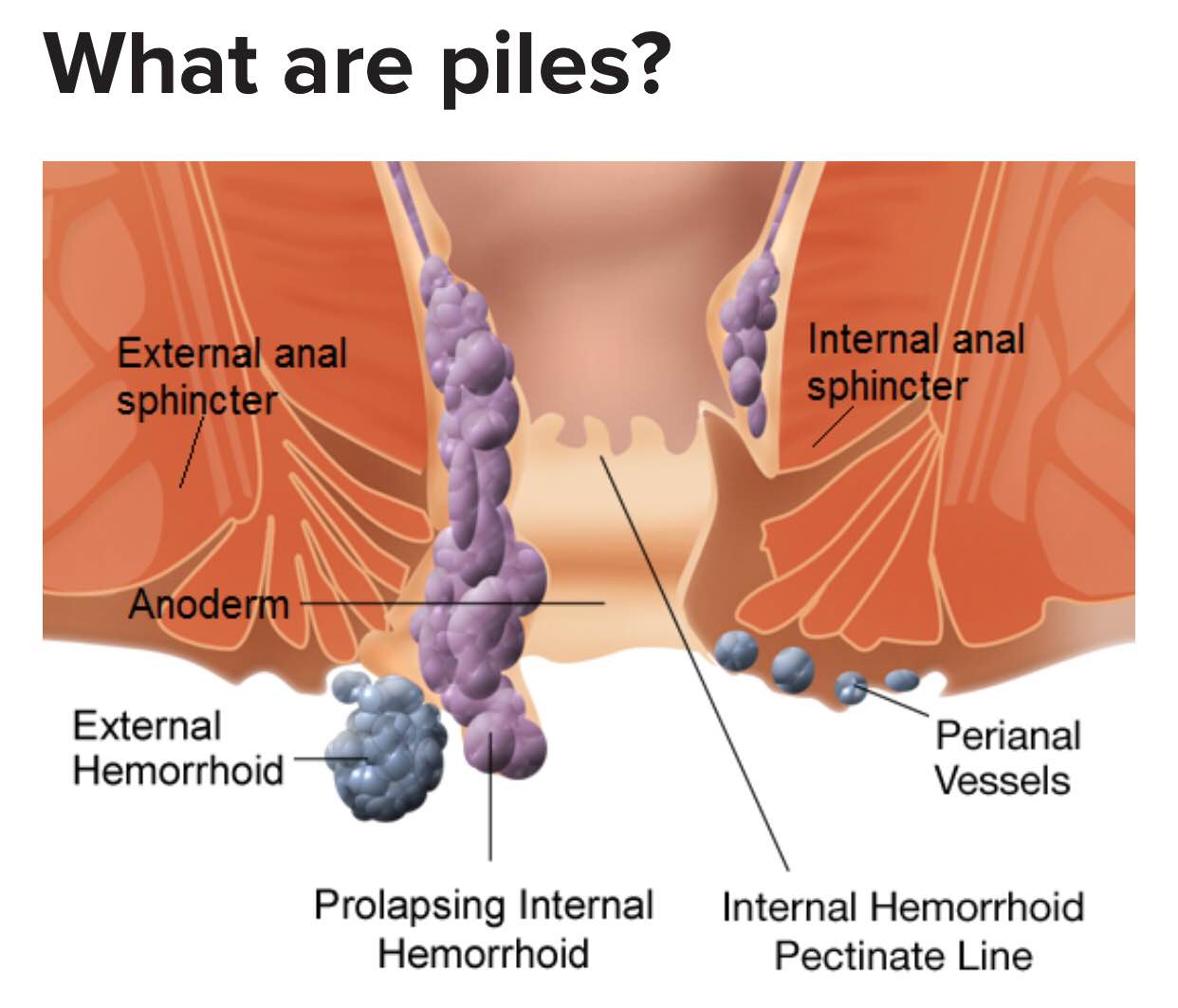 Piles Piles Is Another Term For Hemorrhoids Hemorrhoids Are Collections Of Inflamed Tissue In The Anal Canal They Contain Blood Vessels Support Tissue Muscle And Elastic Fibers Piles Are Collections Of Tissue Piles Piles Is Another Term For Hemorrhoids Hemorrhoids Are Collections Of Inflamed Tissue In The Anal Canal They Contain Blood Vessels Support Tissue Muscle And Elastic Fibers Piles Are Collections Of Tissue