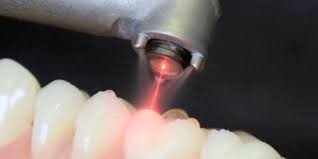 Laser Dentistry in K