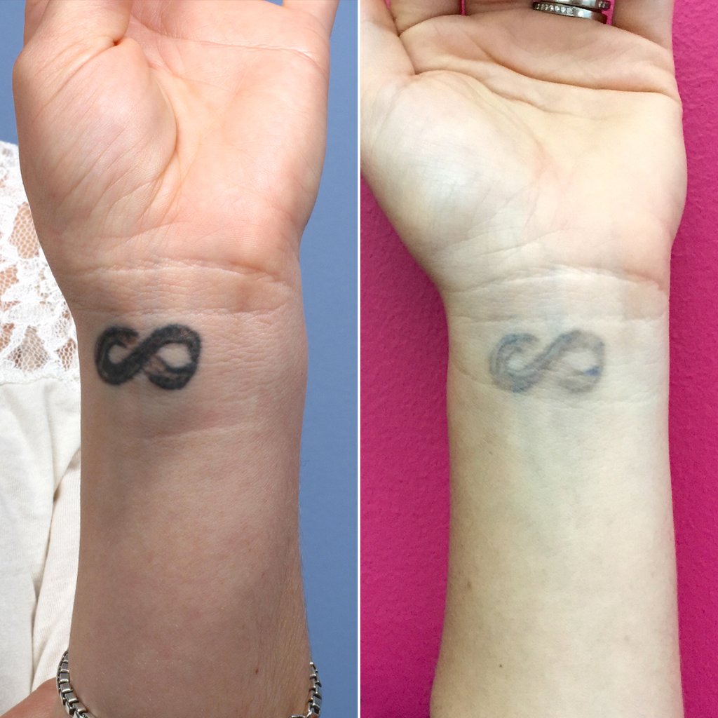 TATOO REMOVAL TREATMENT IN 30% OFF IN MULUND IM... main image