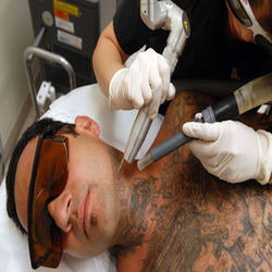 Permanent tattoos arent as permanent as they on... main image