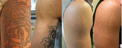 Tattoo Removal Service

Tattoos were used as ma... main image