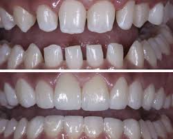 Porcelain Veneers D