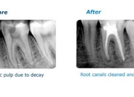 Root canal treatment