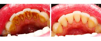 Teeth CleaningGum d
