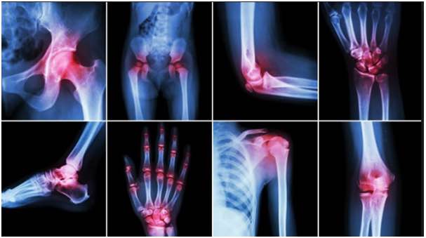 Arthiritis symptoms,