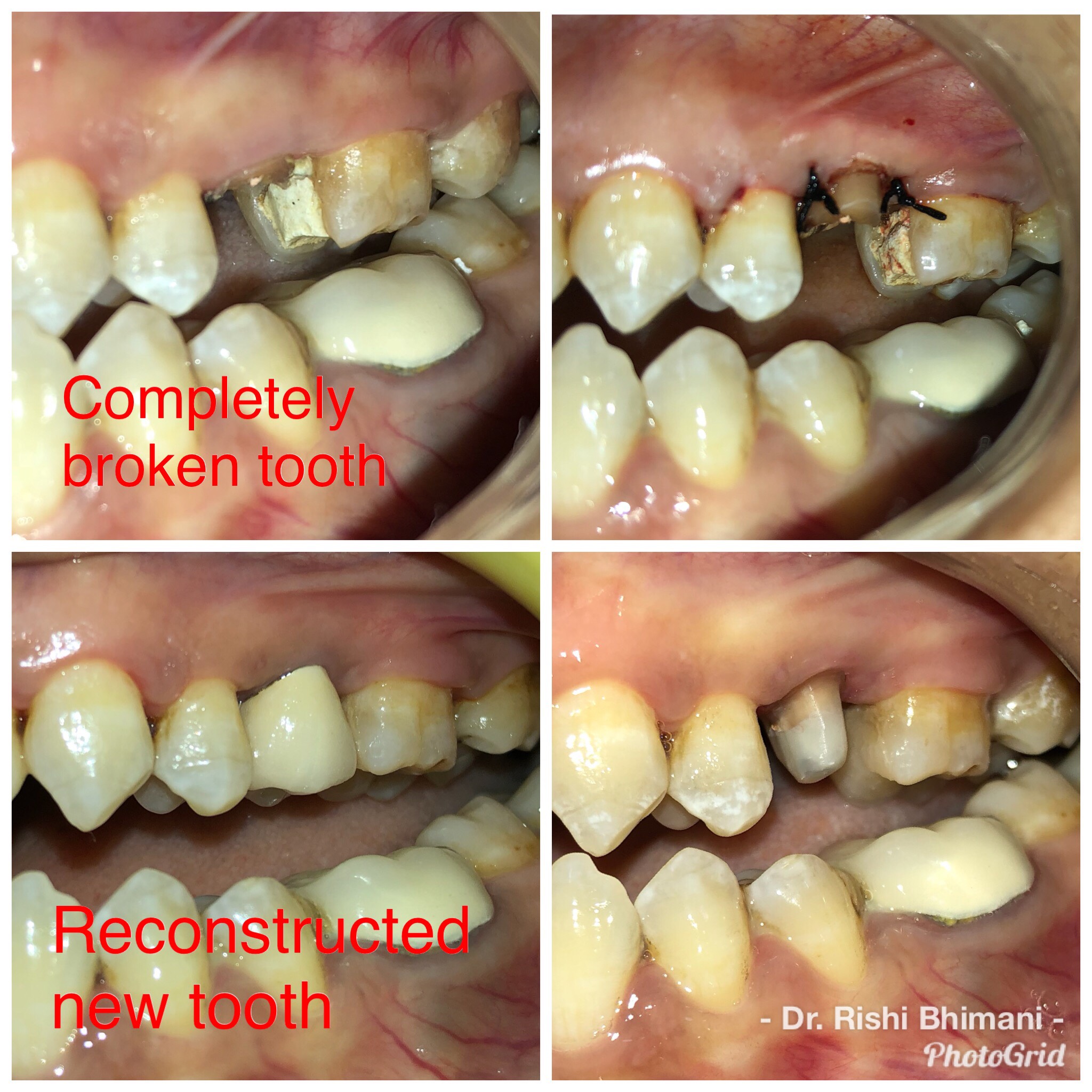 Reconstruction of broken tooth can be done and ... main image