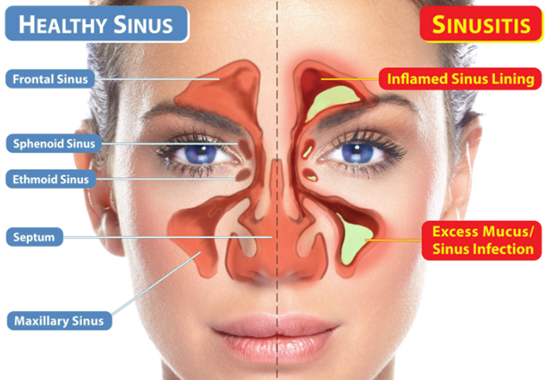 Sinusitis Symptoms,