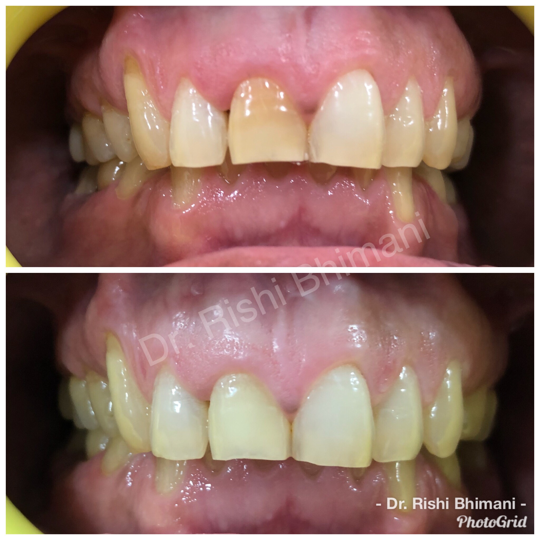 Dark or discolored front tooth can affect the s... main image