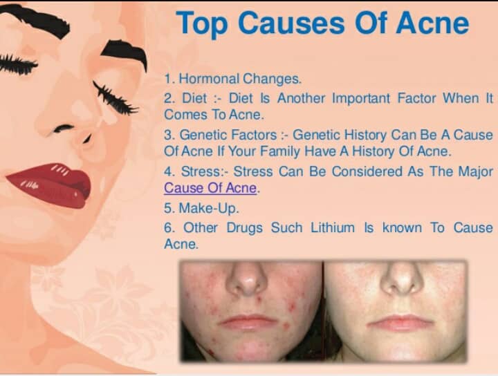 REMOVAL OF ACNEIf