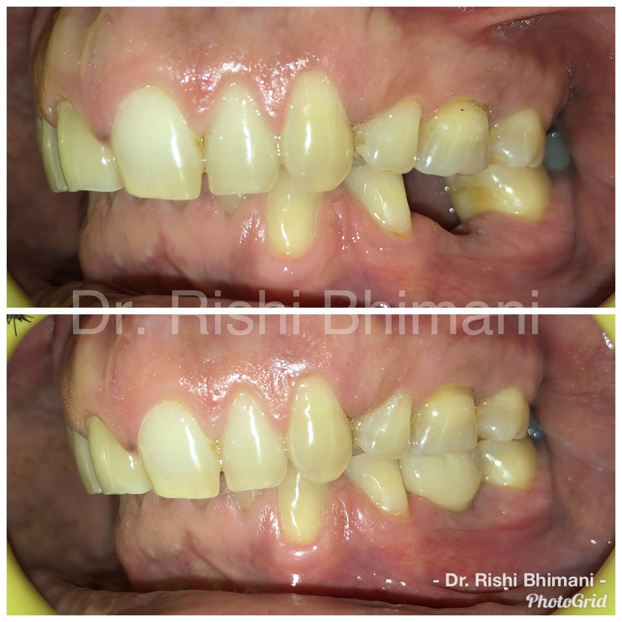 Replacement of missing teeth by dental implants... main image