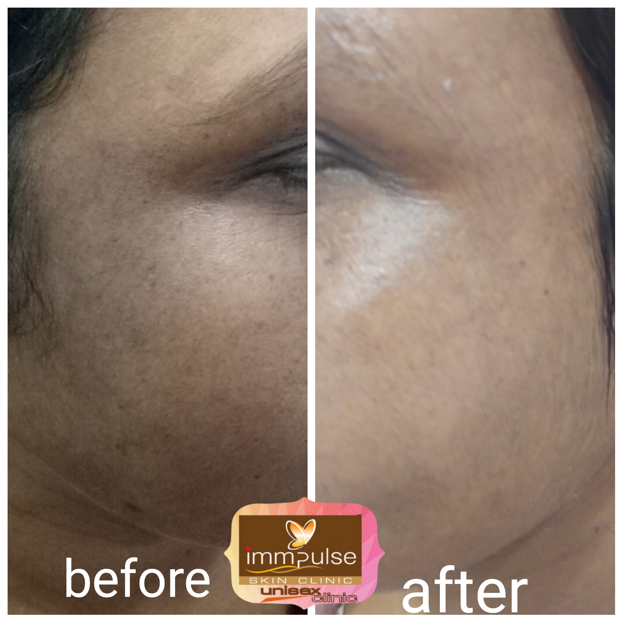 skin lighting treatment , melasma treatment , pigm... main image