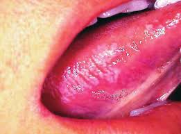 LEUKOPLAKIA commonly