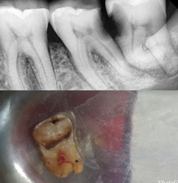 Non surgical extraction of Lower 3rd molar main image