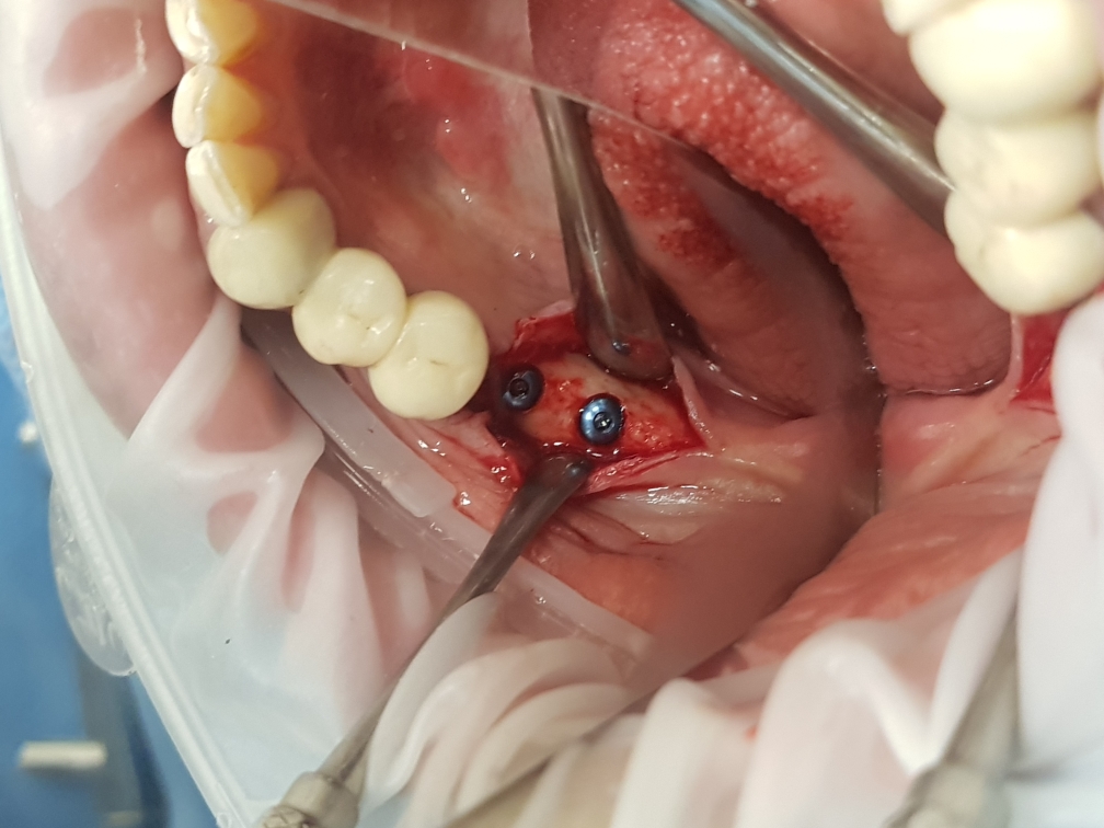 Dental Implants Cost