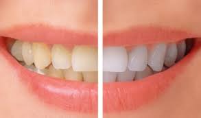 Tooth Whitening brig