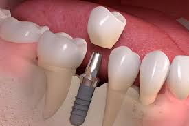 Missing teeth can be