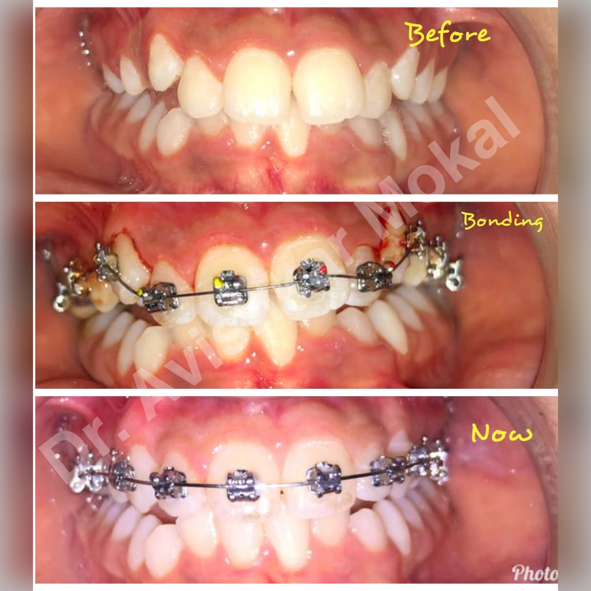 Braces can correct teeth irregularities such as... main image