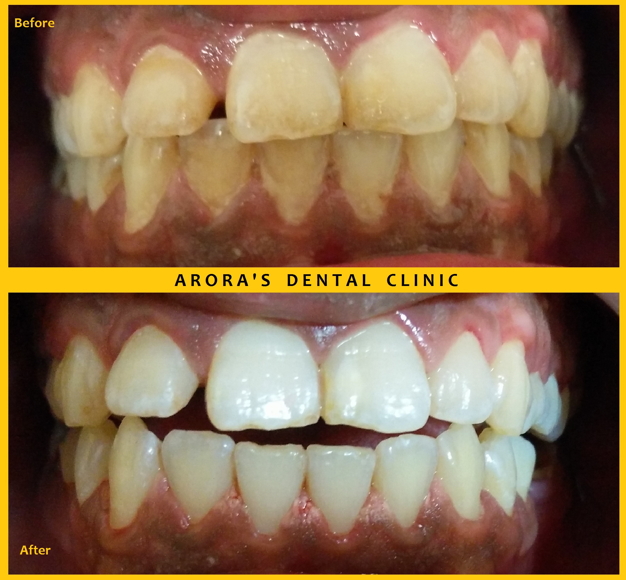 TEETH WHITENING - A