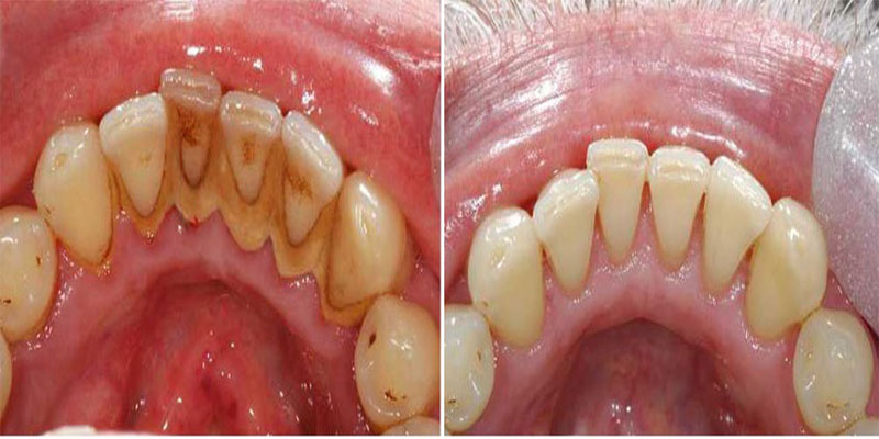 Get your regular Dental Cleanup/Scaling done by ex... main image
