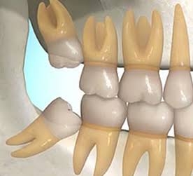 When does a wisdom tooth need to be extracted?
... main image
