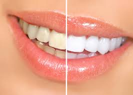 Tooth Whitening brig