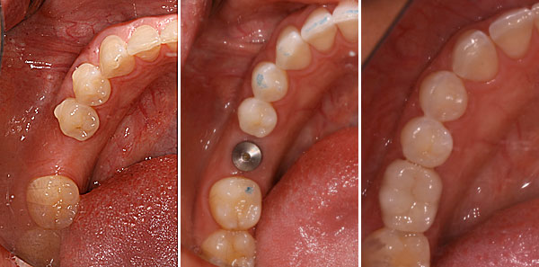 Get your Dental Implants done with Dr Vivek Singh ... main image
