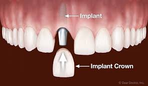 Missing teeth can be