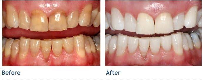 TEETH WHITENING

As we grow older our teeth bec... main image