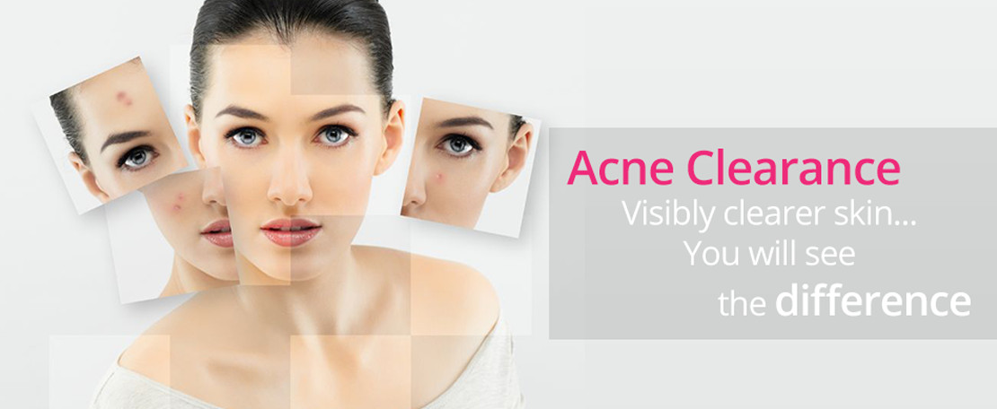 Best Acne Treatment clinic  In Mulund 

visit immp... main image