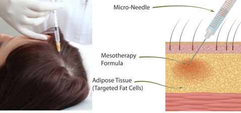 Hair Meso therapy is a treatment which gives a ... main image