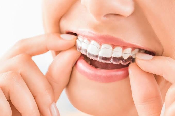 HOW TO STRAIGHTEN TEETH WITHOUT BRACES?

Some d... main image