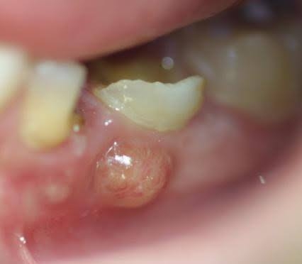 DENTAL ABSCESS

A dental abscess, or tooth absc... main image