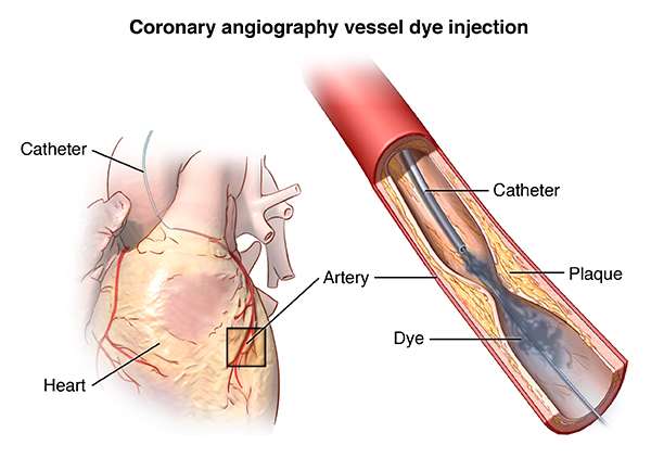 CORONARY CATHERISATION

A coronary catheterizat... main image