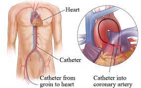 Coronary catheterization :-

A coronary angiogr... main image