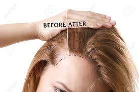 Mesotherapy is a baldness treatment that triggers ... main image