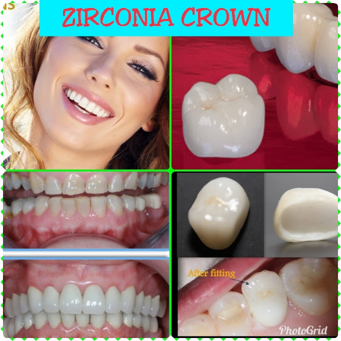 ZIRCONIA CROWN

Zirconium crowns are one of the... main image