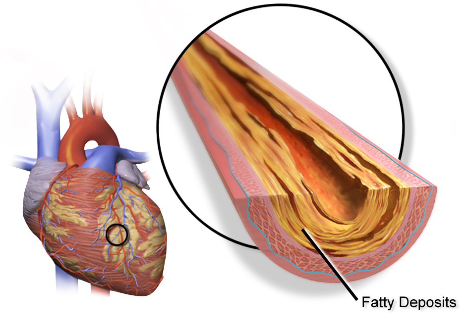 Coronary Angiogram:
A coronary angiogram is a p... main image