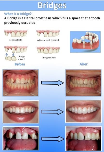 FIXED DENTAL PROSTHESIS / TEETH

It has been re... main image