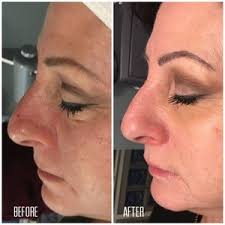 How does Carbon Facial work?

Carbon Facial Gi... main image