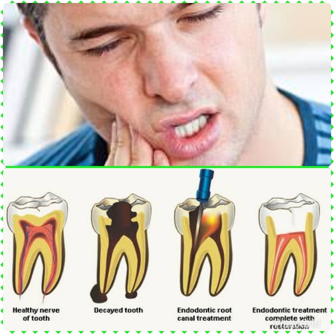 ROOT CANAL TREATMENT
Cavities are also called t... main image